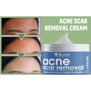 KURAIY Acne Cream Remove Acnes Pimples Whiten Dark Spot Scars Anti Acne Treatment Gel Shrink Pores Oil Control Face Care