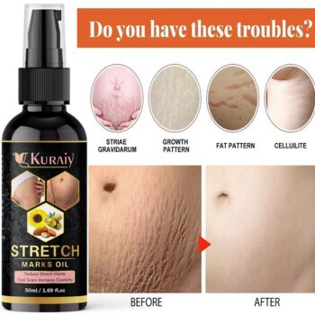 Kuraiy Natural Actives Stretch Marks Removal Cream Oil for Women in During After Pregnancy (50 ml)