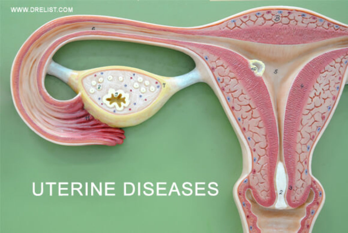 Ayurvedic Medicine for Uterine