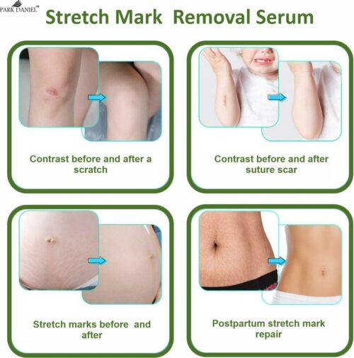 stretch mark removal serum soothes dry skin pack of 4 of 30ml original imagp298gcwmpk5f